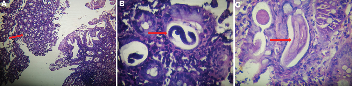 (A) Histopathology photomicrograph showing duodenal mucosa with multiple eggs of Strongyloides stercoralis (H and E, ×10). (B) Histopathology photomicrograph showing filariform larvae of Strongyloides stercoralis (H and E, ×40). (C) Histopathology photomicrograph showing rhabditiform larvae of Strongyloides stercoralis (H and E, ×40).